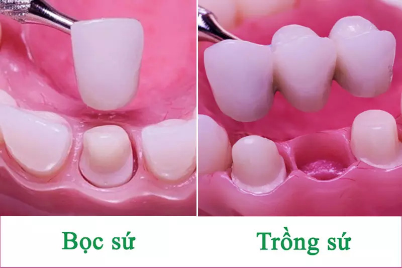 Phân biệt sự khác nhau giữa bọc răng sứ và trồng răng sứ