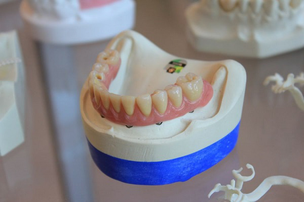 Có những loại phục răng nào hiện nay?