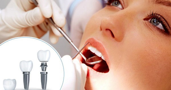 Chăm sóc răng sau khi phục hình răng như thế nào?