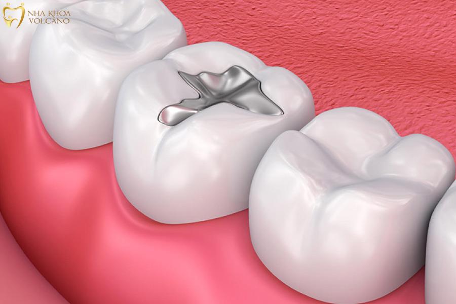 Trám răng bằng Amalgam (trám bạc) Trám răng bằng Amalgam (trám bạc)