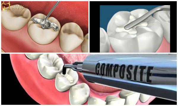 Trám răng bằng Composite Trám răng bằng Composite