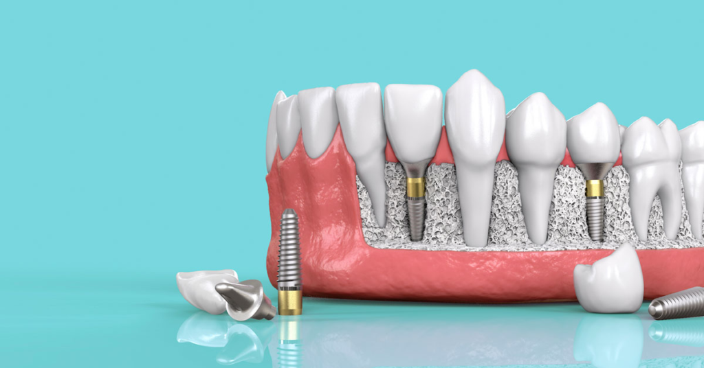 Trồng răng implant có tốt không