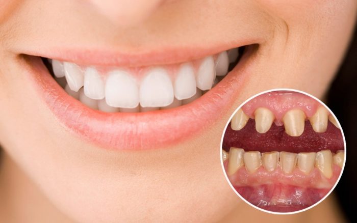 Trồng răng sứ là gì? 
