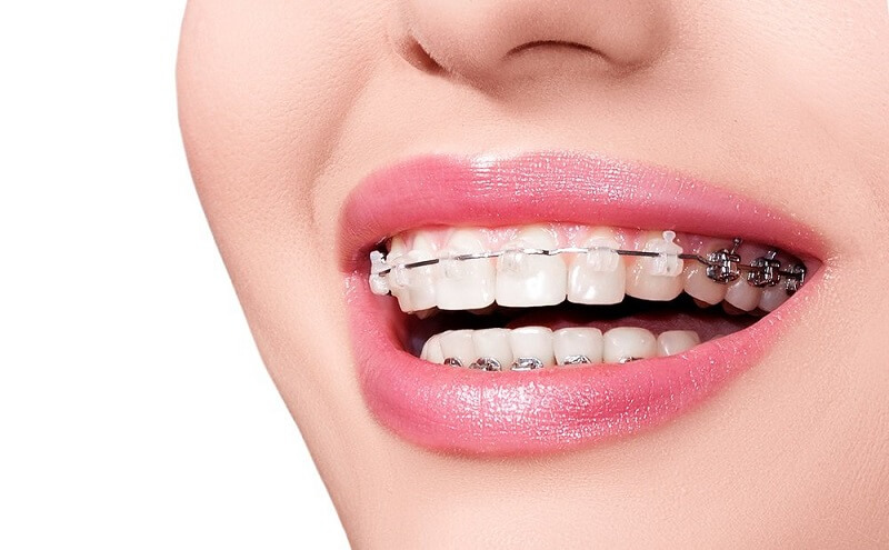 Niềng răng là phương pháp chỉnh hình răng được nhiều người lựa chọn