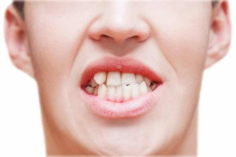 Răng lệch nhiều sẽ có thời gian điều trị lâu hơn