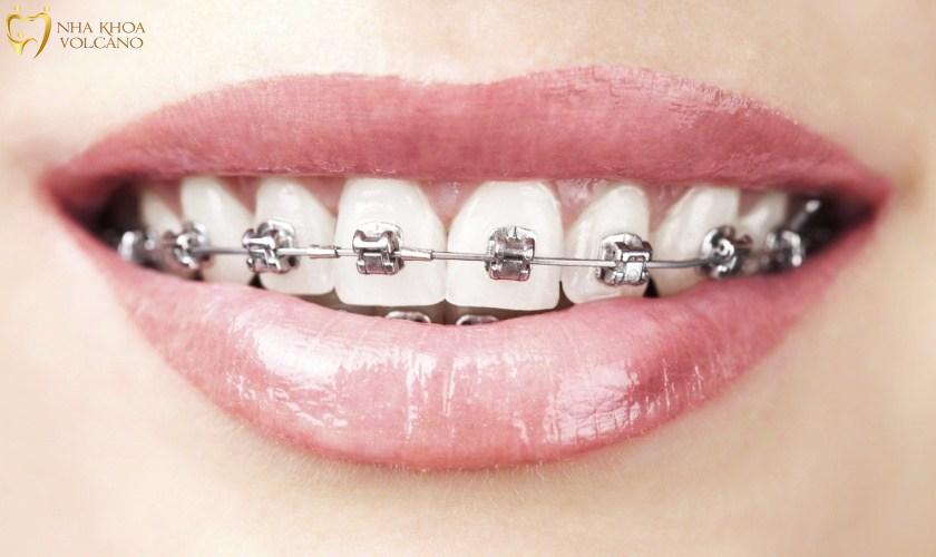 Niềng răng mắc cài kim loại được đánh giá cao về hiệu quả