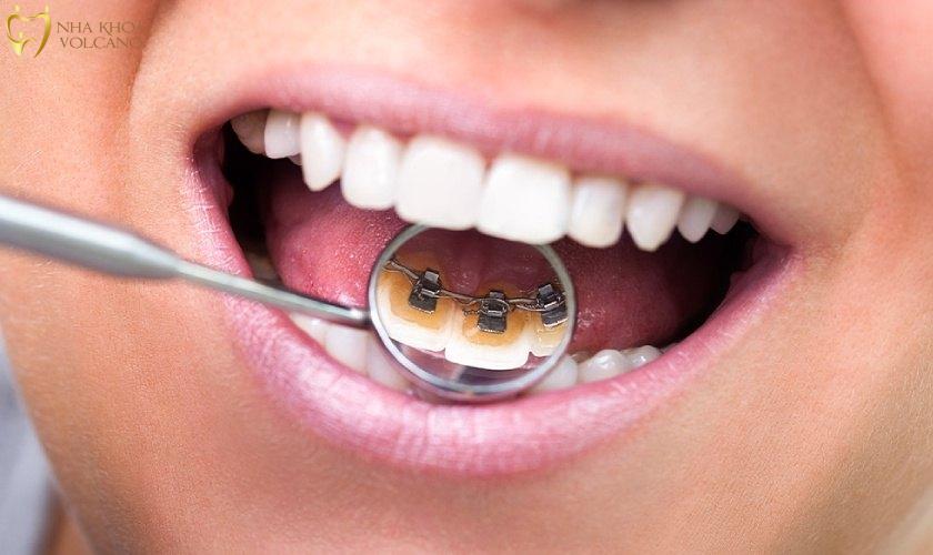 Niềng răng mắc cài mặt trong đòi hỏi bác sĩ phải giỏi, giàu kinh nghiệm