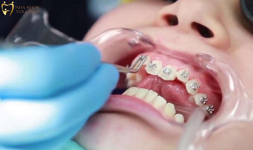 Khi răng đã đều đẹp thì sẽ được tháo mắc cài