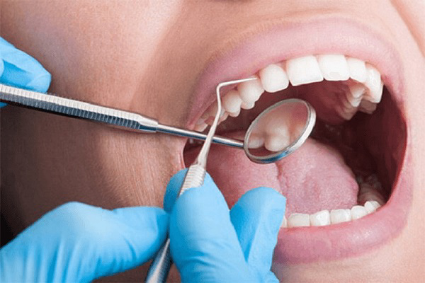 Cạo vôi răng giúp lấy sạch mảng bám trên răng