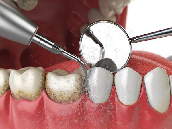 Lấy cao răng giúp hàm răng sạch sẽ và sáng bóng