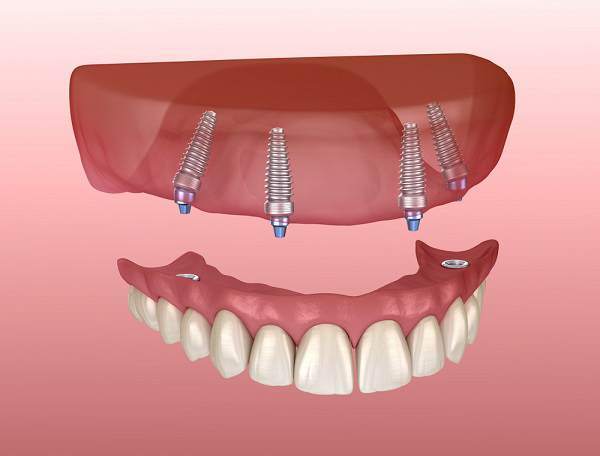 Phục hình tháo lắp giúp cải thiện tình trạng răng miệng