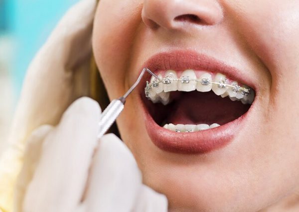 Mỗi giai đoạn niềng răng đều có những điểm riêng biệt