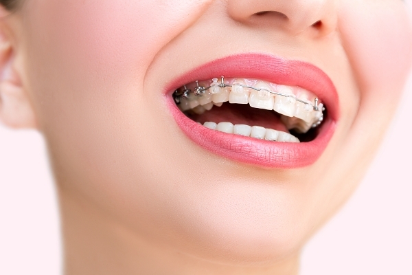 Các câu hỏi phổ biến khi niềng răng hô hàm