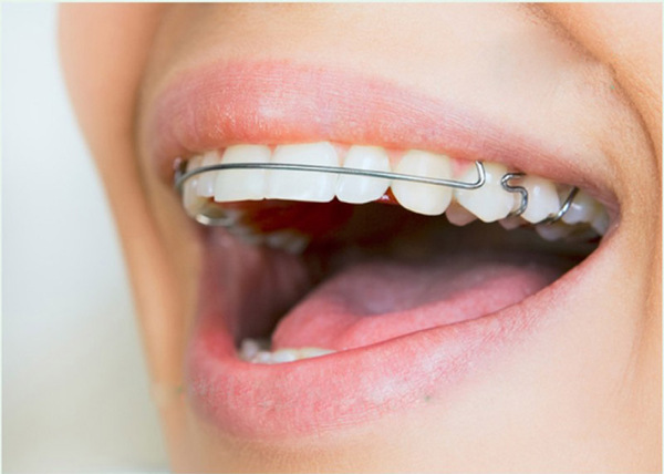 Tìm hiểu các phương pháp niềng răng hô phổ biến