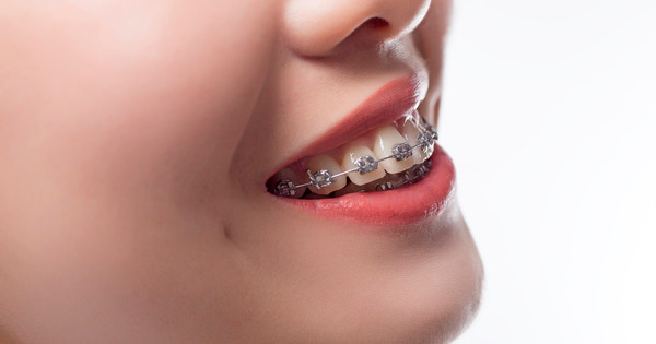 Thông thường niềng răng hô sẽ kéo dài từ 1 - 3 năm