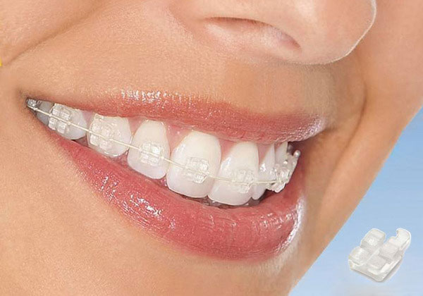 Phương pháp niềng răng mắc cài sứ được nhiều người lựa chọn