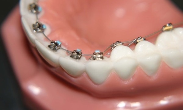 Những trường hợp nào cần niềng răng mắc cài mặt trong?