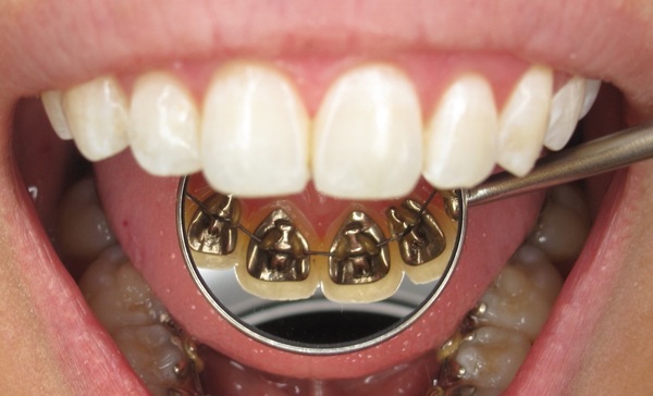 Có 3 loại niềng răng mặt trong phổ biến