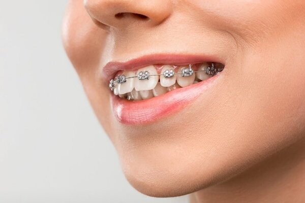 Niềng răng giá rẻ ảnh hưởng như thế nào đến sức khỏe răng miệng?