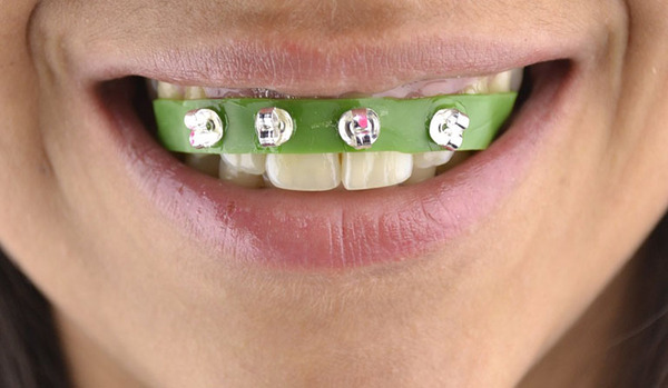 Căn chỉnh răng không đúng cách sẽ khiến răng bạn lệch lạc, lung lay
