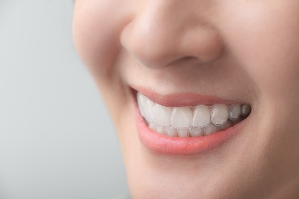 Có rất nhiều phương pháp niềng răng trong suốt khác nhau