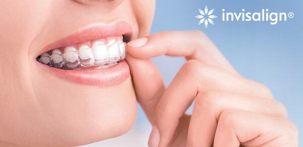 Niềng răng Invisalign là phương pháp phổ biến nhất
