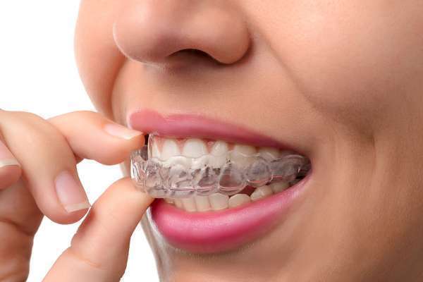 Giá niềng răng trong suốt khá cao từ 80 đến 130 triệu đồng