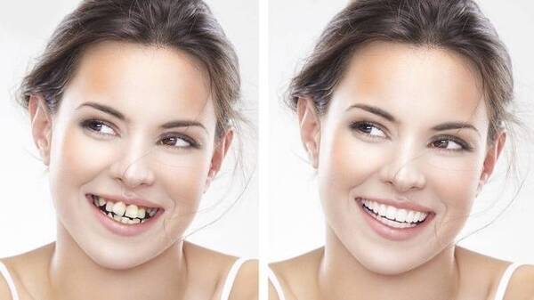 Mức độ thay đổi khuôn mặt sau niềng răng của người lớn ít hơn trẻ em