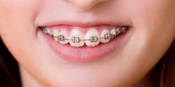 Mức độ lệch của răng ảnh hướng đến thời gian niềng răng