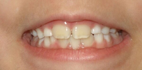 Nguyên nhân gây răng ố vàng ở trẻ em