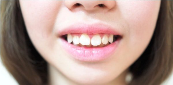 Đâu là phương pháp chỉnh răng mọc lệch không cần niềng hiệu quả?
