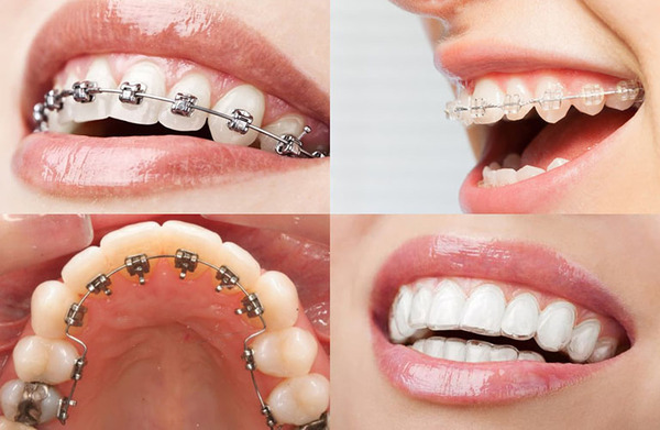 Những vấn đề quan trọng về niềng răng bạn cần nắm rõ