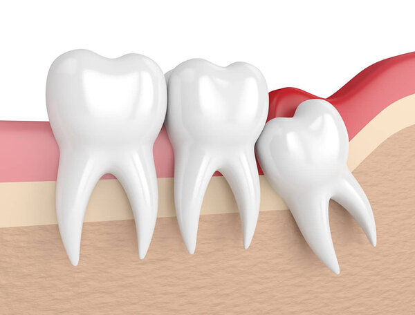 Dấu hiệu mọc răng khôn hàm dưới và cách giảm đau hiệu quả