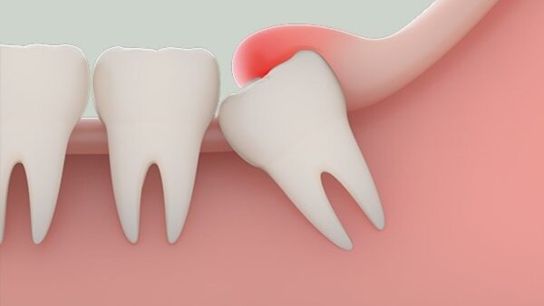 Nguyên nhân gây nên tình trạng mọc răng khôn hàm dưới