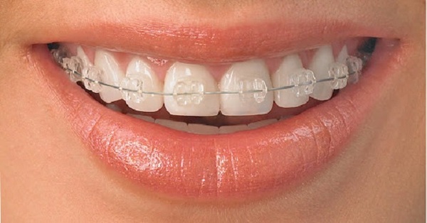 Niềng răng mắc cài pha lê là gì và có tốt hay không?