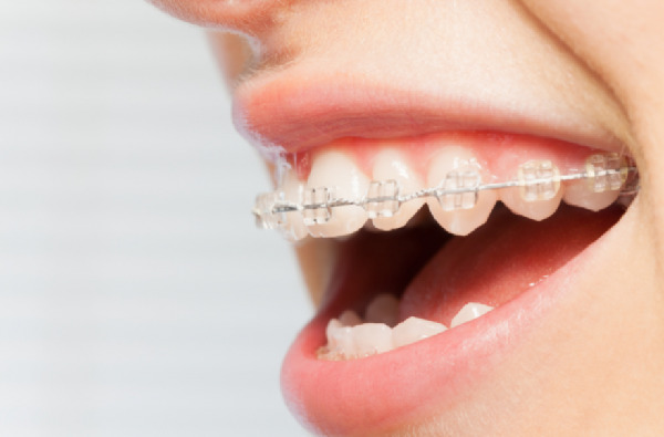 Bạn nên niềng răng tại nha khoa nào?