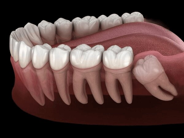 Chèn ép của răng khôn gây nên tình trạng đau đớn