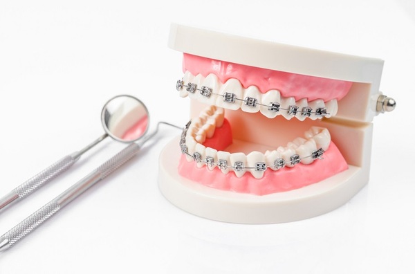 Làm thế nào để khắc phục niềng răng không thành công?
