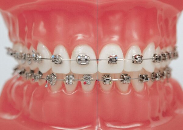Thời gian niềng răng còn phụ thuộc vào tình trạng răng của bạn
