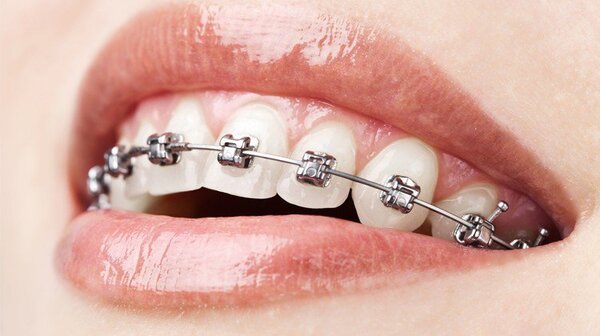 Bạn nên niềng răng sắt trong trường hợp nào?