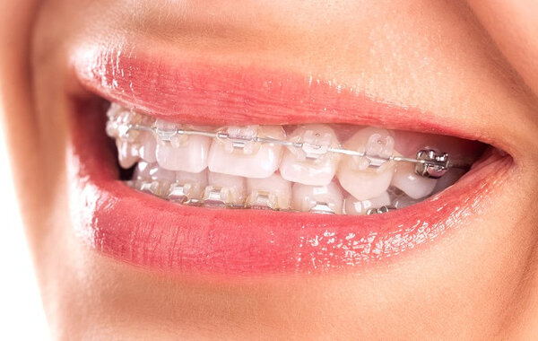 Các ưu điểm của phương pháp niềng răng chỉnh nha bằng mắc cài sứ