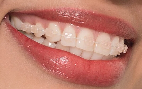 Niềng răng mắc cài trong suốt là gì và có hiệu quả không?