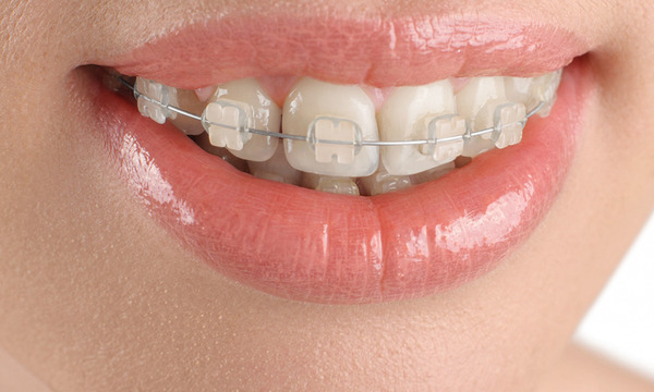 Tìm hiểu ngay các ưu điểm của phương pháp niềng răng này