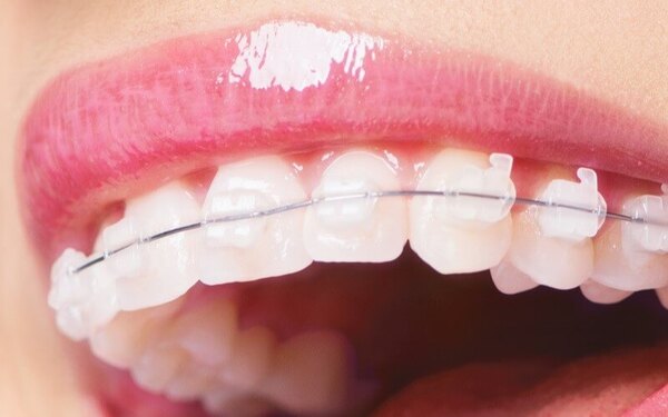 Quy trình niềng răng mắc cài trong suốt như thế nào?
