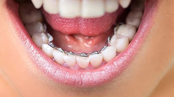 Niềng răng mặt lưỡi là gì?