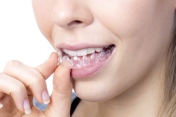 Niềng răng trong suốt mất bao lâu?