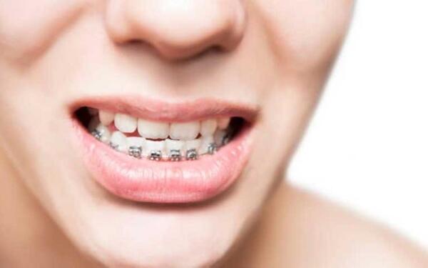 Có rất nhiều nguyên nhân dẫn đến tình trạng xấu sau khi niềng răng