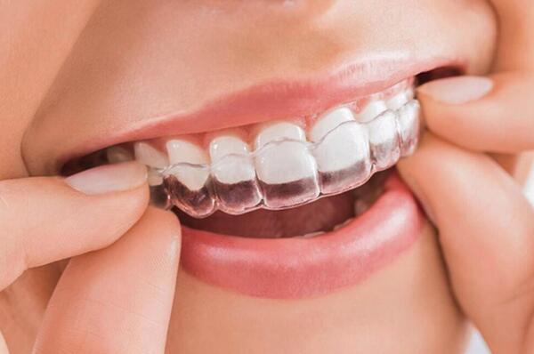 Niềng răng điều chỉnh nhiều tình trạng răng khác nhau và đem lại tính thẩm mỹ