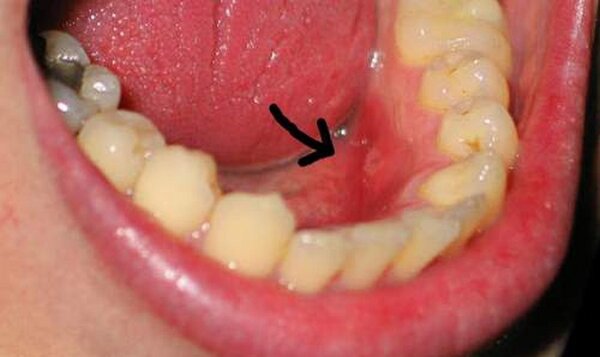 Triệu chứng của sưng nướu răng hàm dưới