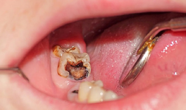 Cách nhận biết và điều trị răng sâu vào tủy